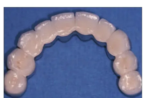 Restoring Full Arch Functionality: The Mechanics of Six-Point Prosthetic Systems